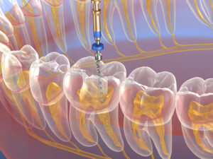 endodontia