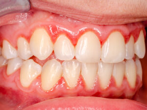 periodontia